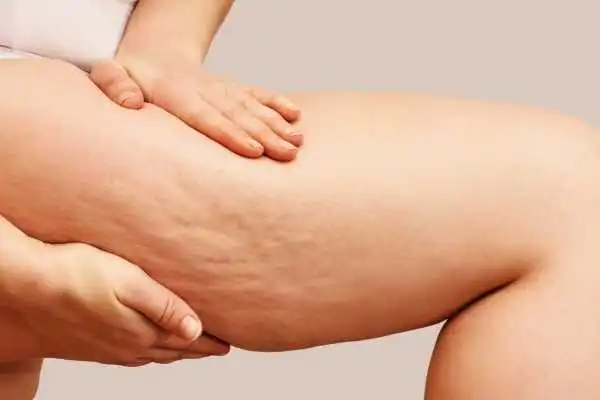 Image of woman showing leg with cellulite Taunton
