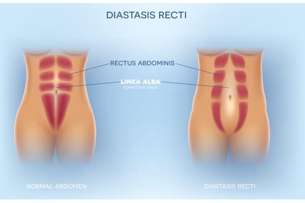 What Non-Surgical Options Are Available for Diastasis Recti Taunton?