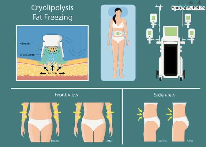 Image of diet and fat freezing combined for best results for Spire Aesthetics Taunton