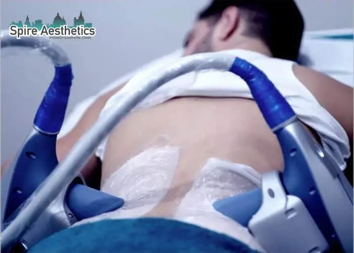 Man having fat freezing treatment done on love handles before a competitions Taunton to create a sculpted look.