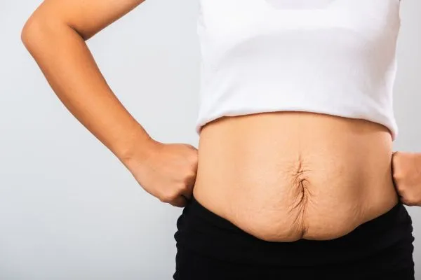 Image of a woman's stomach after weight loss with sagging skin following a gastric band Taunton