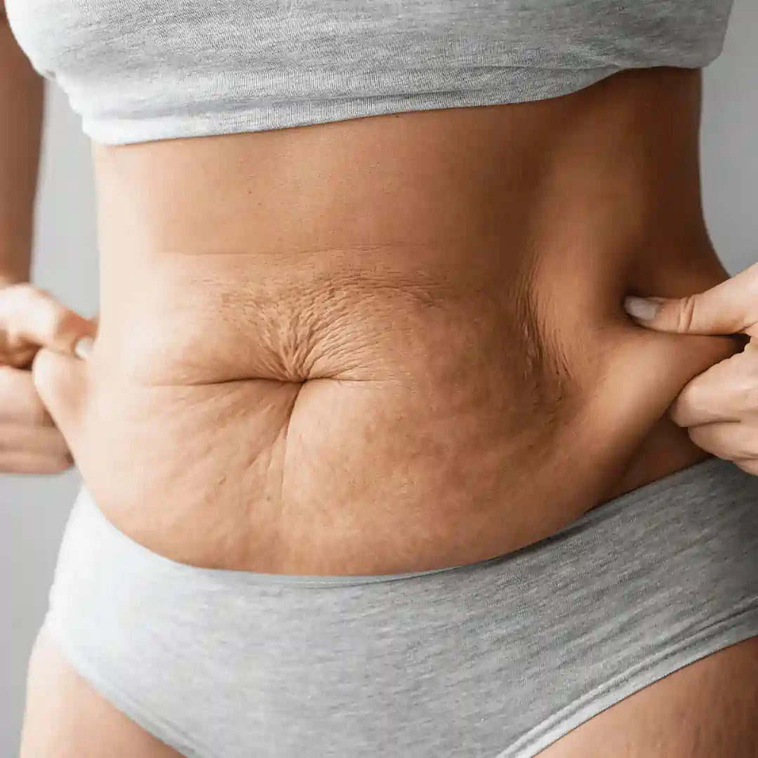 Is It Normal to Have Loose Skin After Pregnancy Taunton?