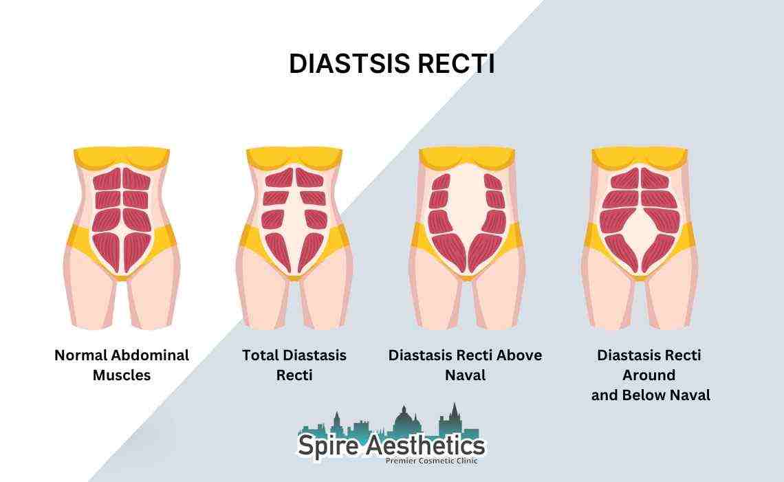 Is Non-Surgical Diastasis Recti Treatment Right for You? Common Concerns Answered Taunton